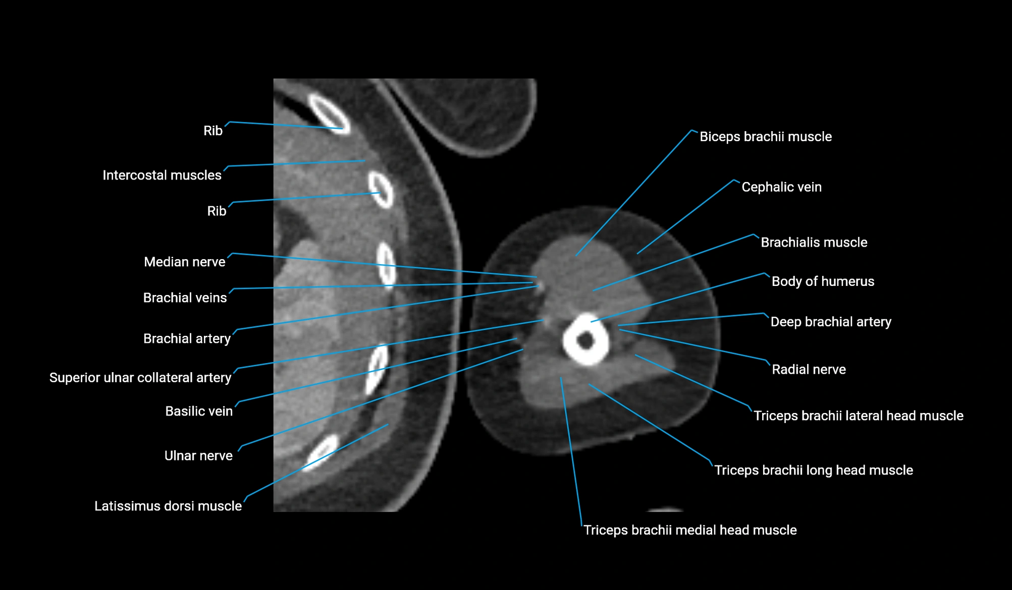 CT upper arm axial  cross sectional anatomy labelled radiology image -00292.webp